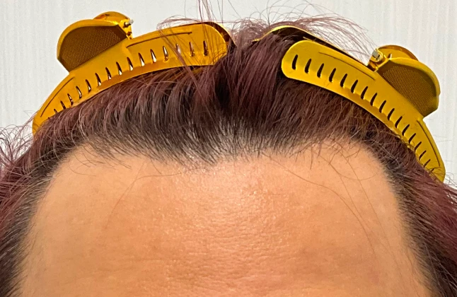 施術前の症例画像