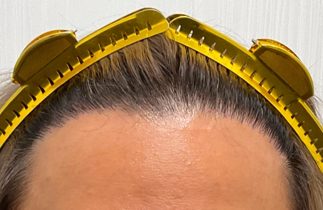 施術後の症例画像