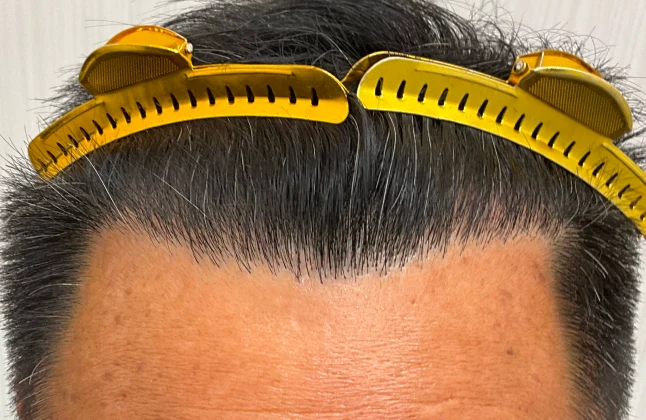 施術後の症例画像