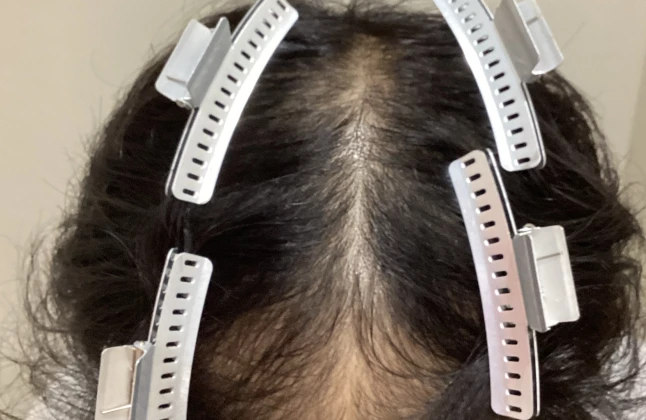 施術前の症例画像