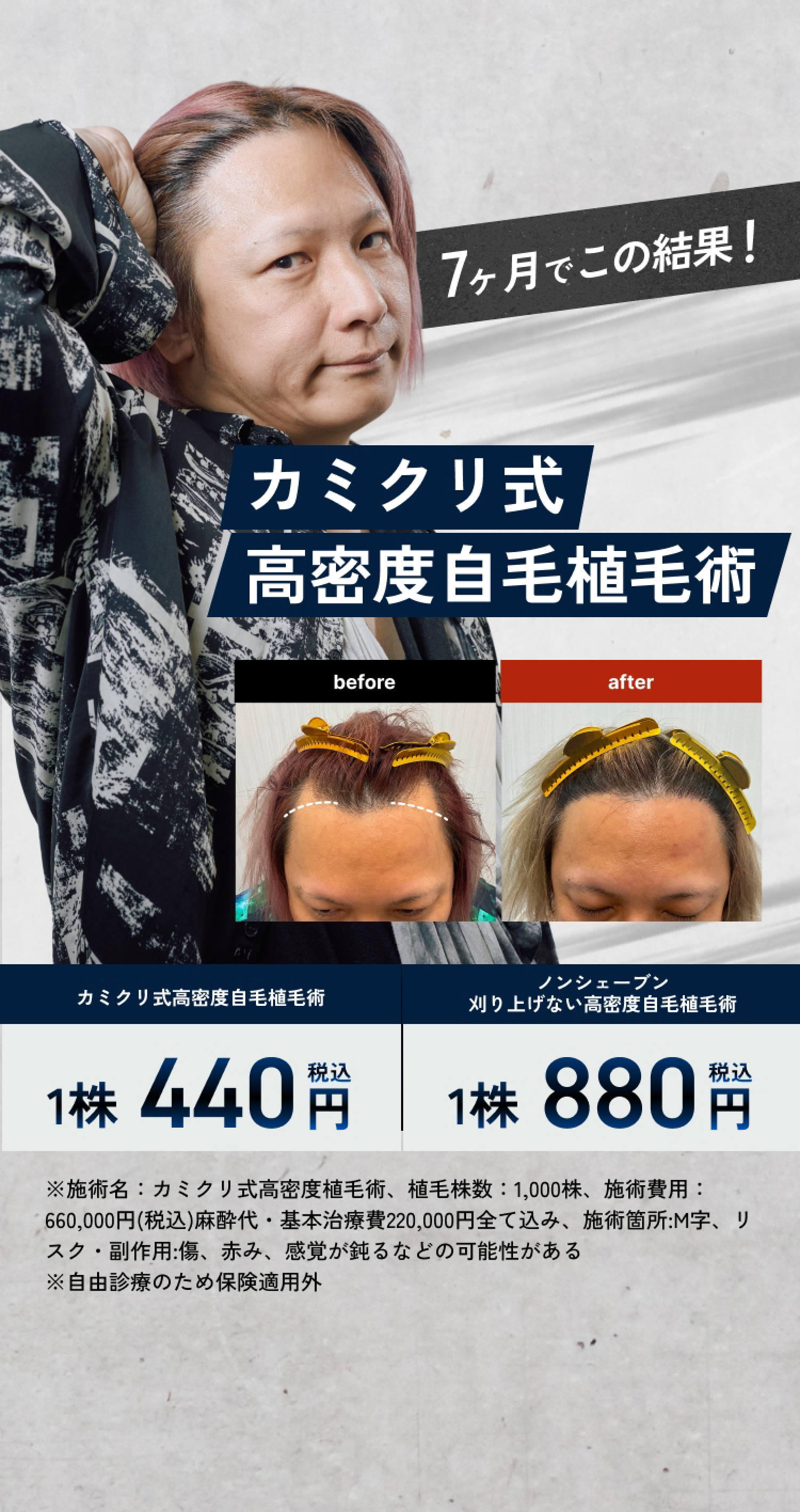 カミクリ式高密度自毛植毛術1株440円(税込) カミクリ式ノンシェーブン植毛術1株880円(税込)