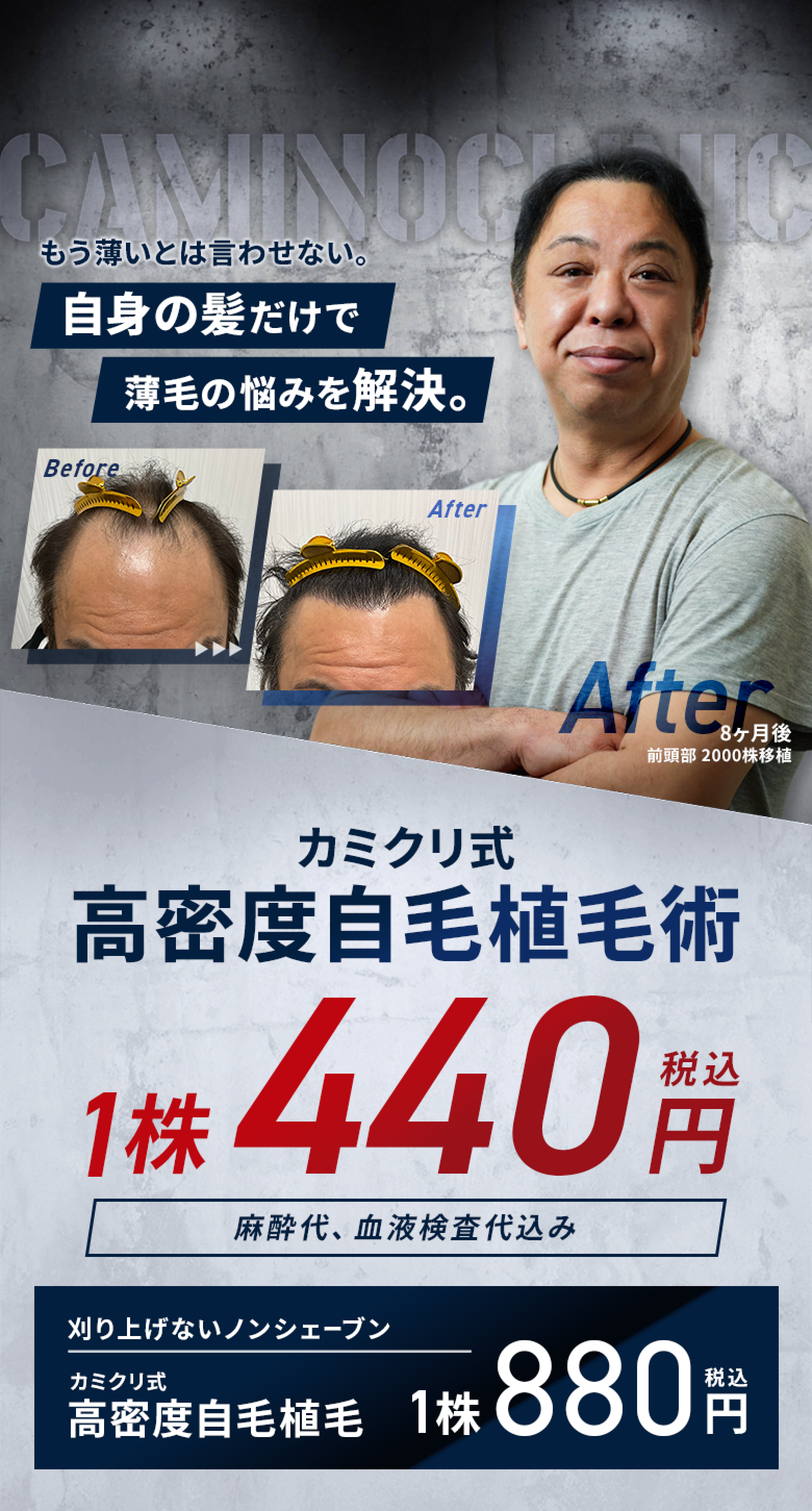 カミクリ式高密度自毛植毛術1株440円(税込) カミクリ式ノンシェーブン植毛術1株880円(税込)