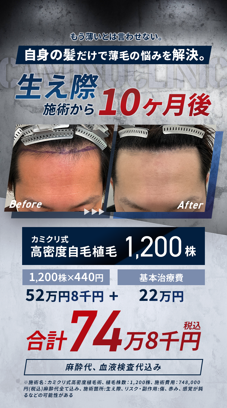カミクリ式高密度自毛植毛術1株440円(税込) カミクリ式ノンシェーブン植毛術1株880円(税込)