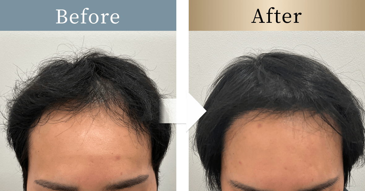 beforeとafterの画像
