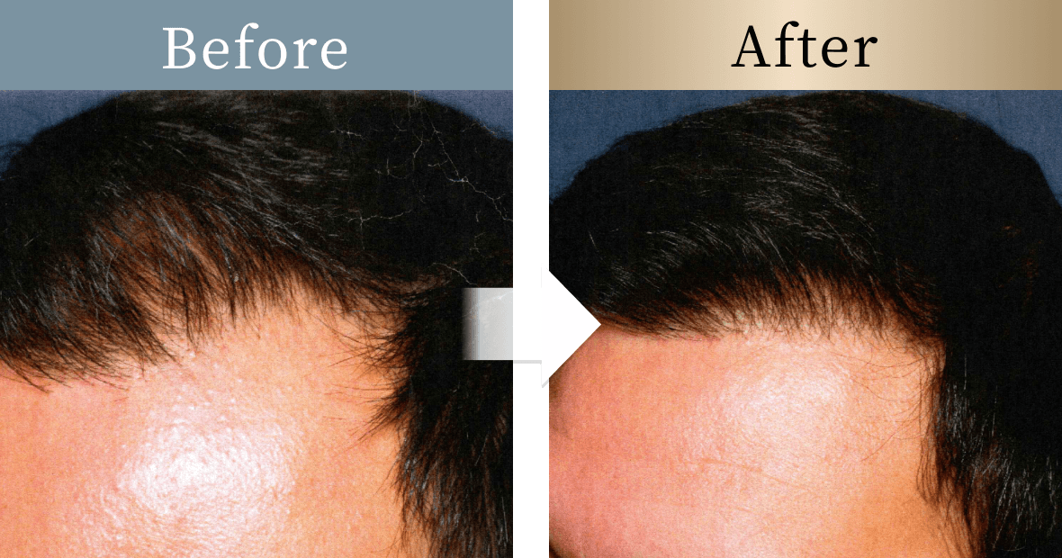 beforeとafterの画像