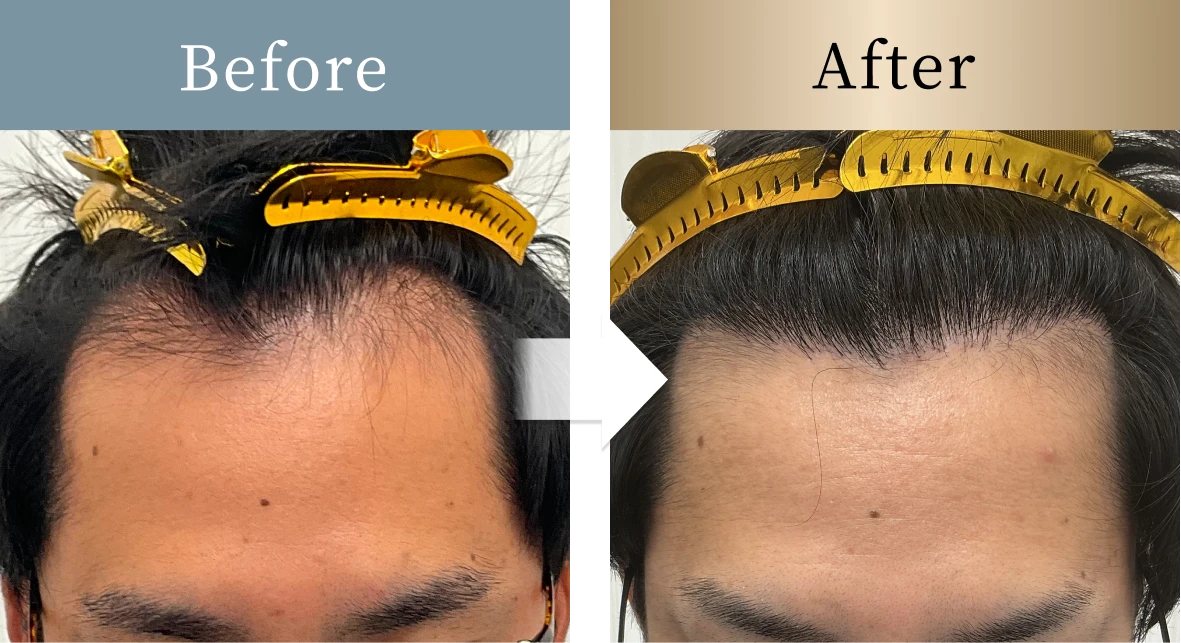 beforeとafterの画像