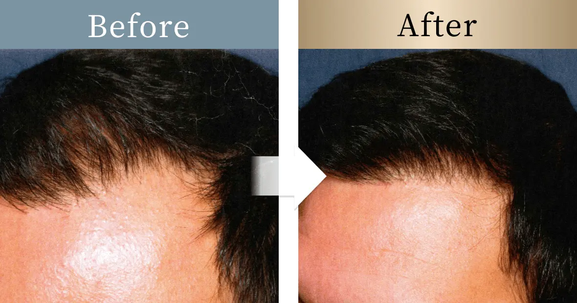 beforeとafterの画像