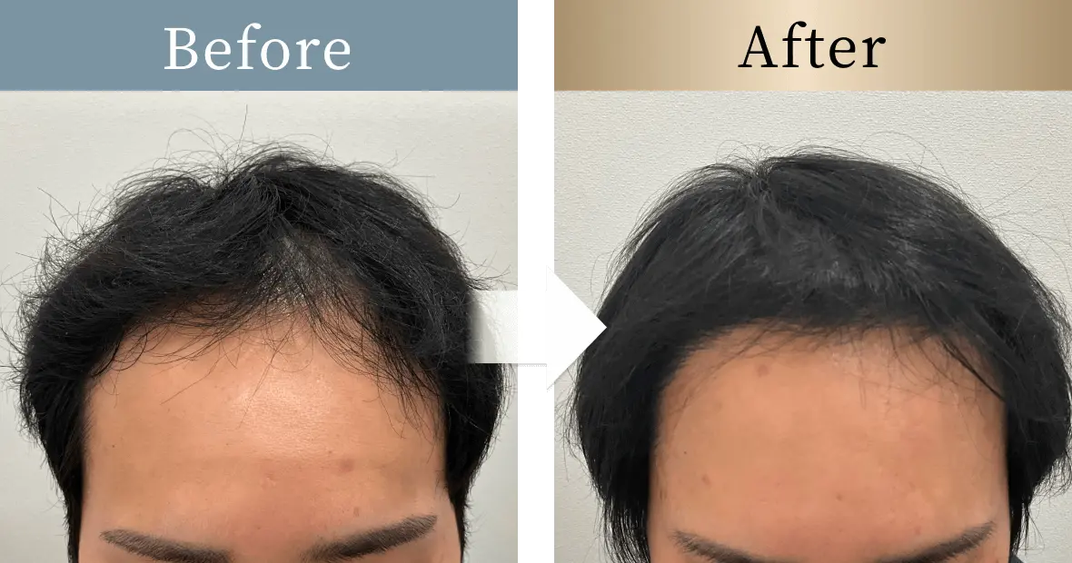 beforeとafterの画像