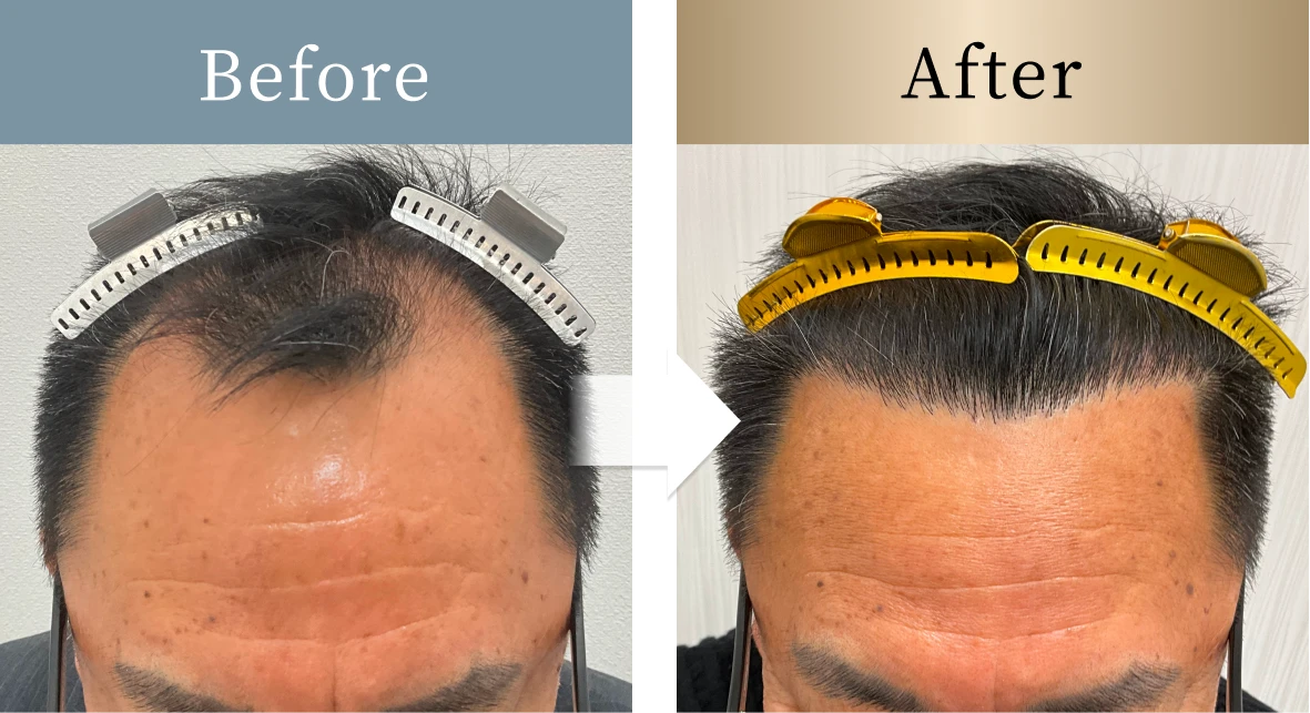 beforeとafterの画像