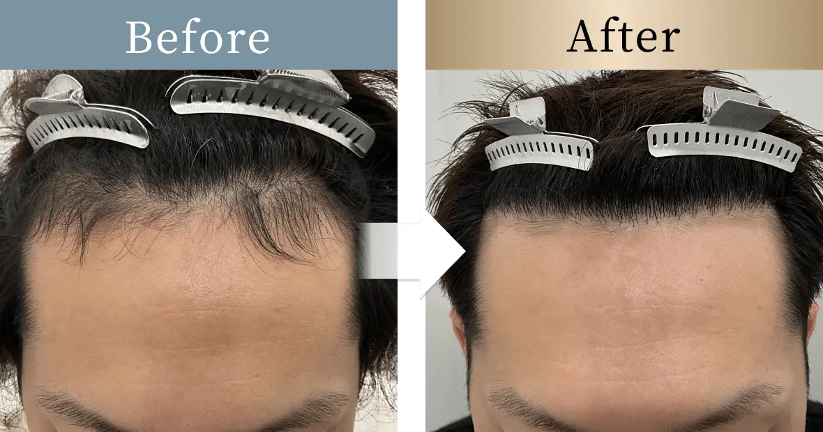 beforeとafterの画像