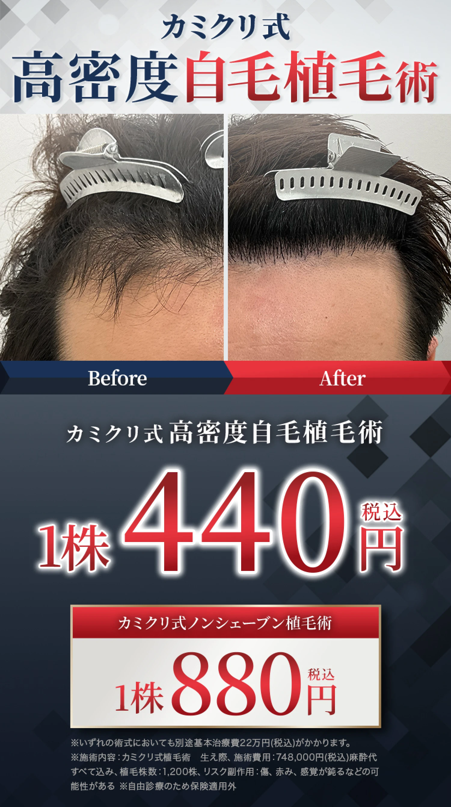 カミクリ式高密度自毛植毛術1株440円(税込) カミクリ式ノンシェーブン植毛術1株880円(税込)