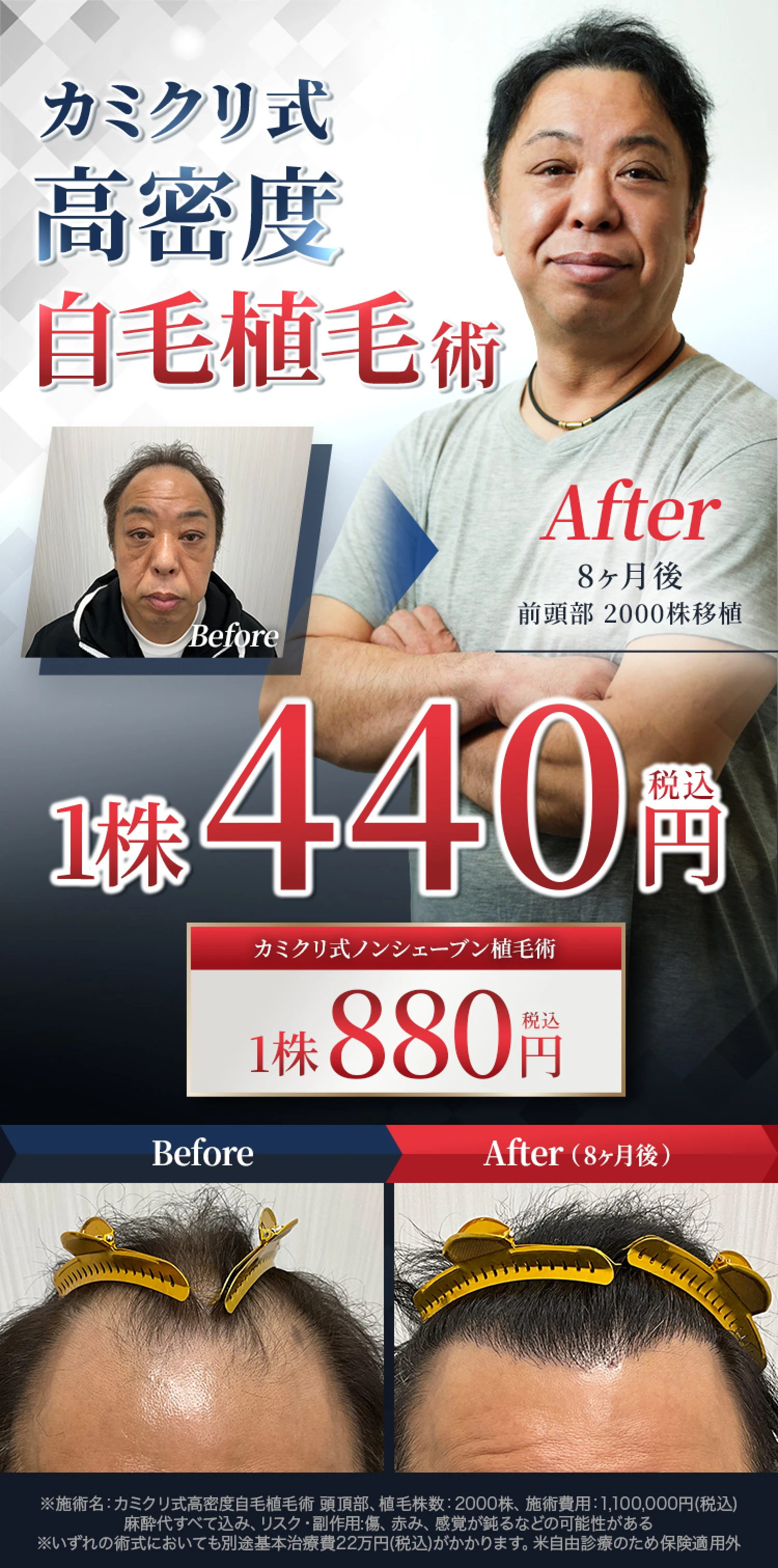 カミクリ式高密度自毛植毛術1株440円(税込) カミクリ式ノンシェーブン植毛術1株880円(税込)