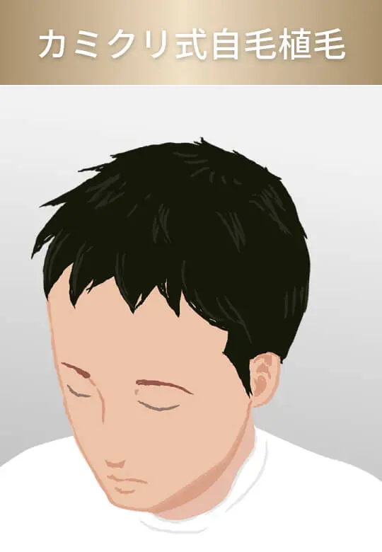 カミクリ式自毛植毛