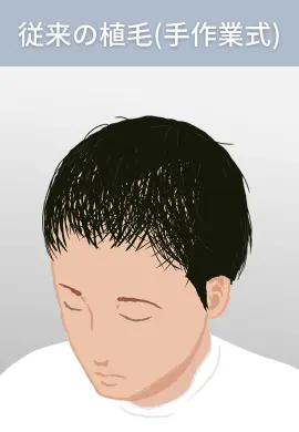 従来の植毛(機械式)