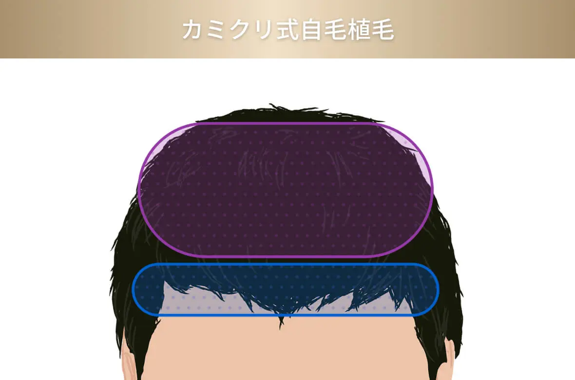 カミクリ式自毛植毛